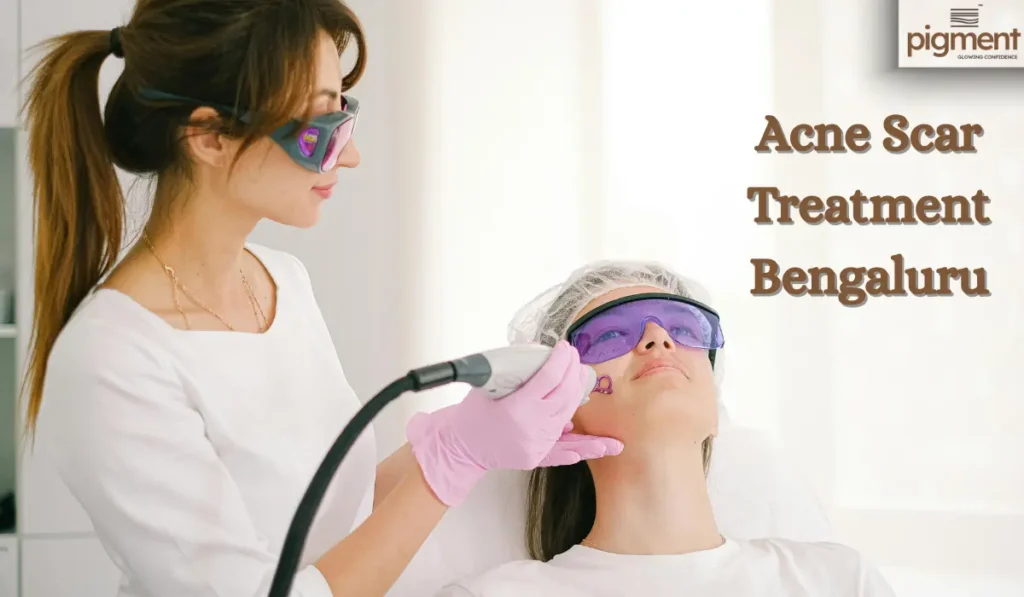 Dermatologist-approved acne scar treatment at Pigment Skin & Hair Clinic Bengaluru using advanced lasers, MNRF, and PRP therapies