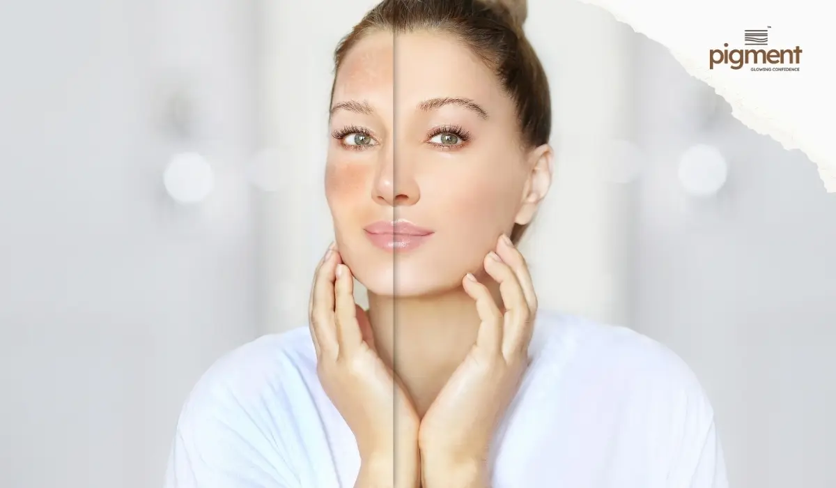 Combination melasma treatments like lasers, peels and TXA used by dermatologists in Bangalore
