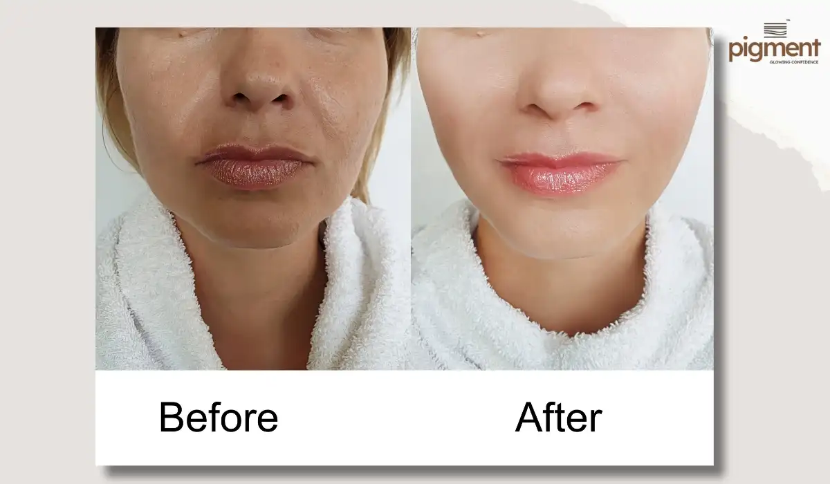 Before and after skin improvement results shown after MNRF treatment in Bangalore