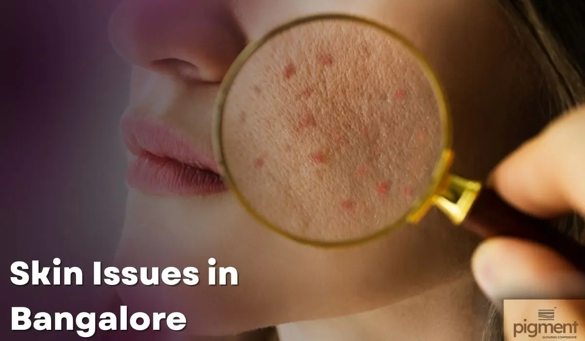 Dry and irritated skin caused by Bangalore’s winter weather and low humidity