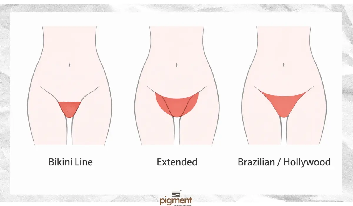 Diagram showing the difference between bikini line, extended bikini, and full brazilian laser hair removal zones.

