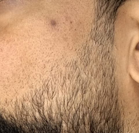 After Scar Treatment