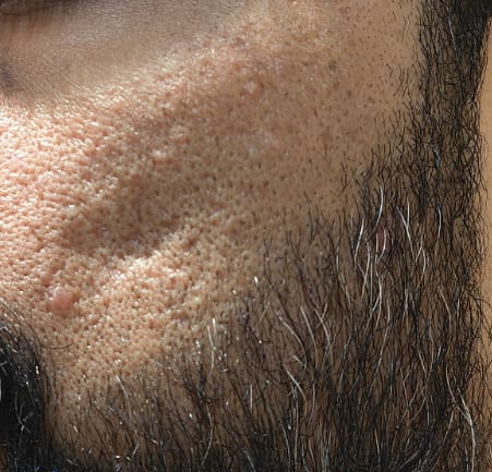 Before Scar Treatment
