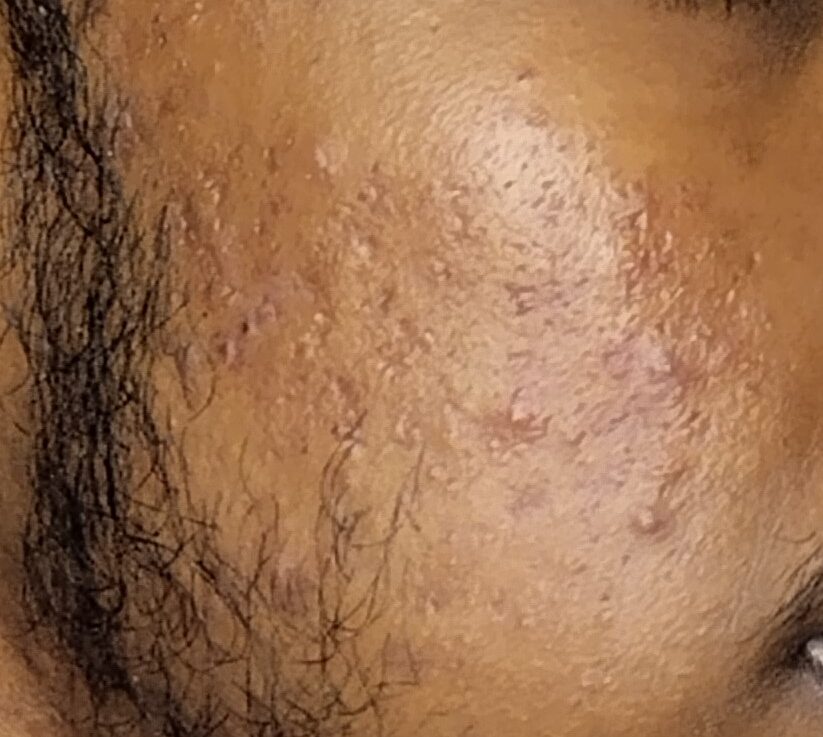 After Scar Treatment