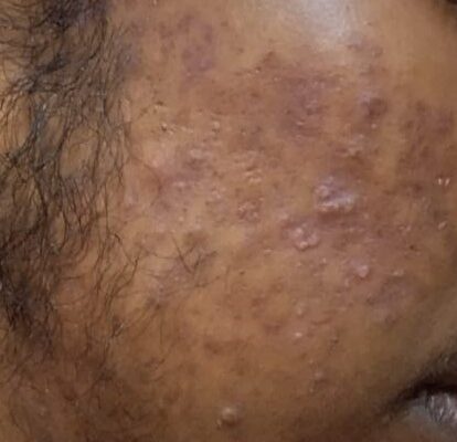 Before Scar Treatment
