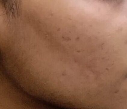 After Acne Treatment
