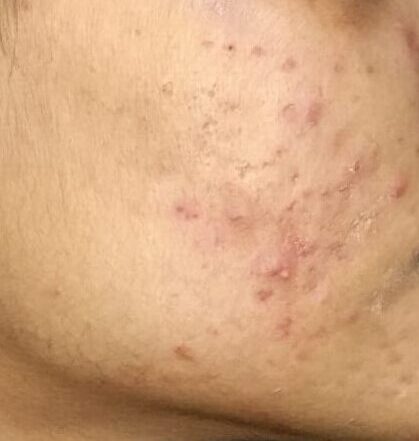 Before Acne Treatment
