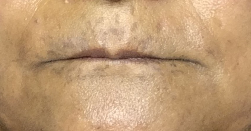 After_Melasma Treatment