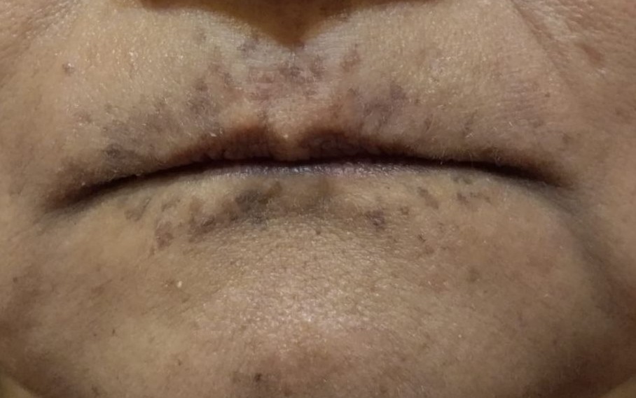 Before_Melasma Treatment