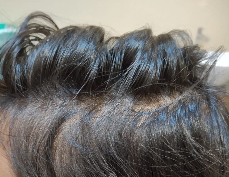 After Scar Treatment