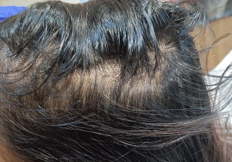 Before Scar Treatment