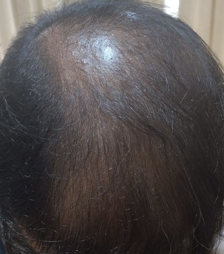 After Hairfall Treatment