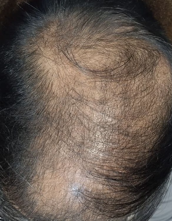 Before Hairfall Treatment