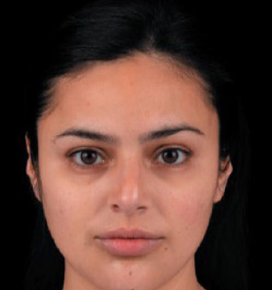 After Add Contour to Your Cheeks